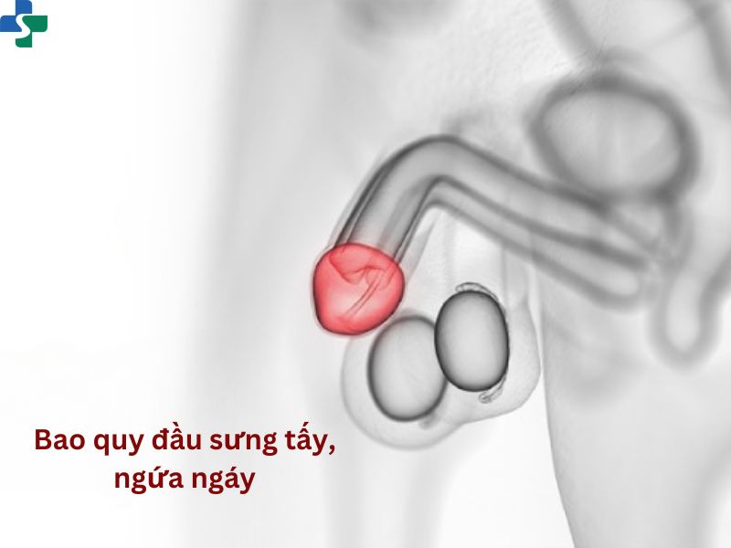Bao quy đầu sưng tấy, ngứa ngáy