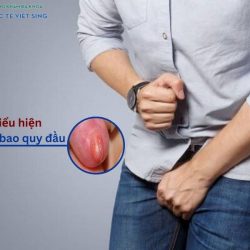 https://phongkhamvietsing.vn/wp-content/uploads/2024/07/bieu-hien-viem-bao-quy-dau-2-250x250.jpg