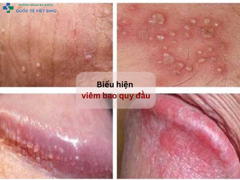 Biểu hiện viêm bao quy đầu