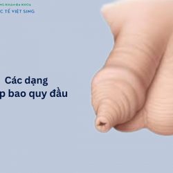 https://phongkhamvietsing.vn/wp-content/uploads/2024/07/cac-dang-hep-bao-quy-dau-250x250.jpg