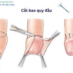 https://phongkhamvietsing.vn/wp-content/uploads/2024/07/cat-bao-quy-dau-hep-250x250.jpg