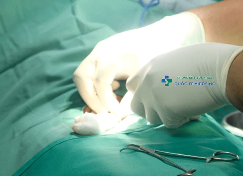 Cắt viêm bao quy đầu nặng