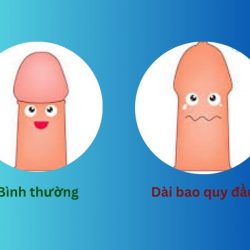 https://phongkhamvietsing.vn/wp-content/uploads/2024/07/dai-bao-quy-dau-250x250.jpg