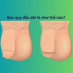 https://phongkhamvietsing.vn/wp-content/uploads/2024/07/dai-bao-quy-dau-la-nhu-the-nao-250x250.jpg