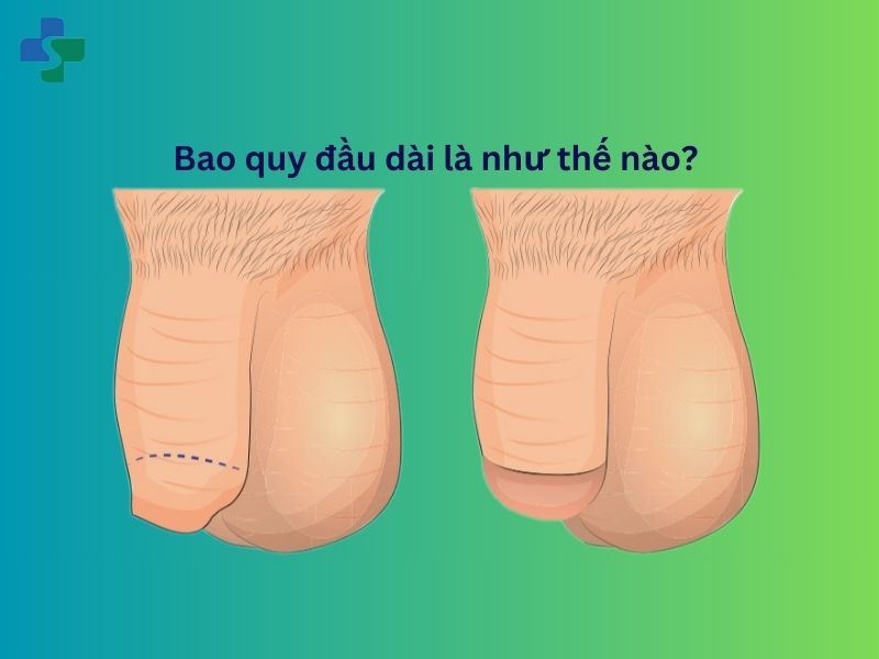 Bao quy đầu dài là như thế nào?