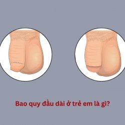 https://phongkhamvietsing.vn/wp-content/uploads/2024/07/dai-bao-quy-dau-o-tre-250x250.jpg
