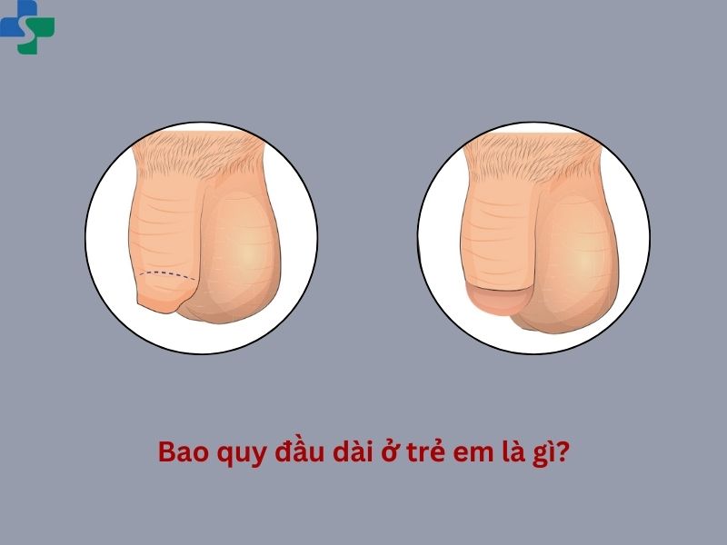 Bao quy đầu dài ở trẻ em