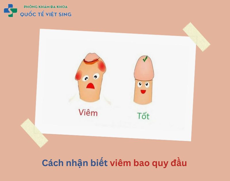 dấu hiệu nhận biết bệnh viêm bao quy đầu