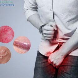 https://phongkhamvietsing.vn/wp-content/uploads/2024/07/dau-hieu-viem-bao-quy-dau-250x250.jpg