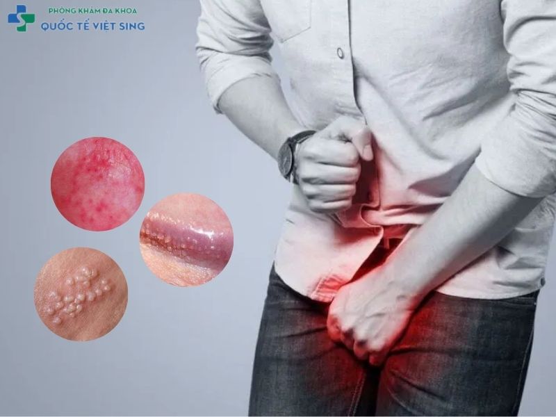 Dấu hiệu viêm bao quy đầu