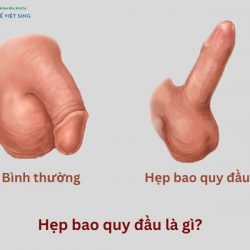 https://phongkhamvietsing.vn/wp-content/uploads/2024/07/hep-bao-quy-dau-la-gi-250x250.jpg