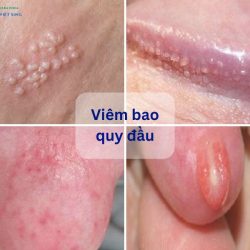 https://phongkhamvietsing.vn/wp-content/uploads/2024/07/hinh-anh-viem-bao-quy-dau-250x250.jpg