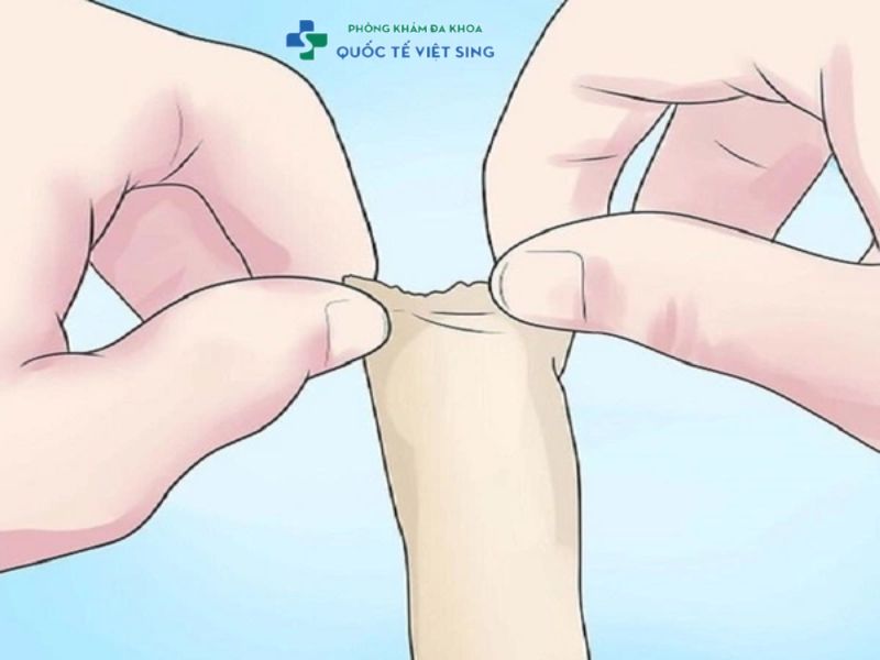 Lột bao quy đầu cho trẻ không đúng cách