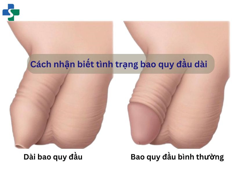 Cách nhận biết tình trạng bao quy đầu dài