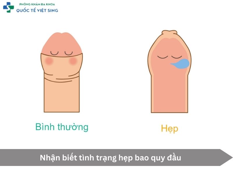 Nhận biết tình trạng hẹp bao quy đầu