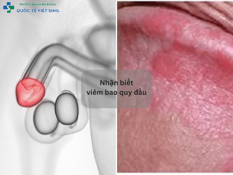 Nhận biết viêm bao quy đầu 