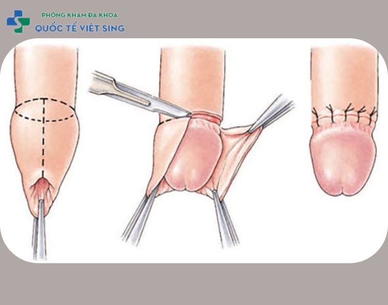 Thủ thuật cắt bao quy đầu 