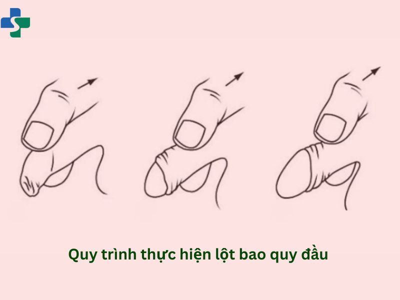 Quy trình thực hiện lột bao quy đầu 