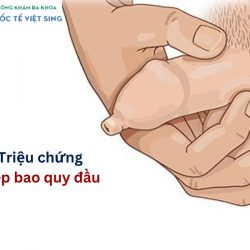 https://phongkhamvietsing.vn/wp-content/uploads/2024/07/trieu-chung-hep-bao-quy-dau-250x250.jpg