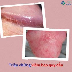 https://phongkhamvietsing.vn/wp-content/uploads/2024/07/trieu-chung-viem-bao-quy-dau-250x250.jpg