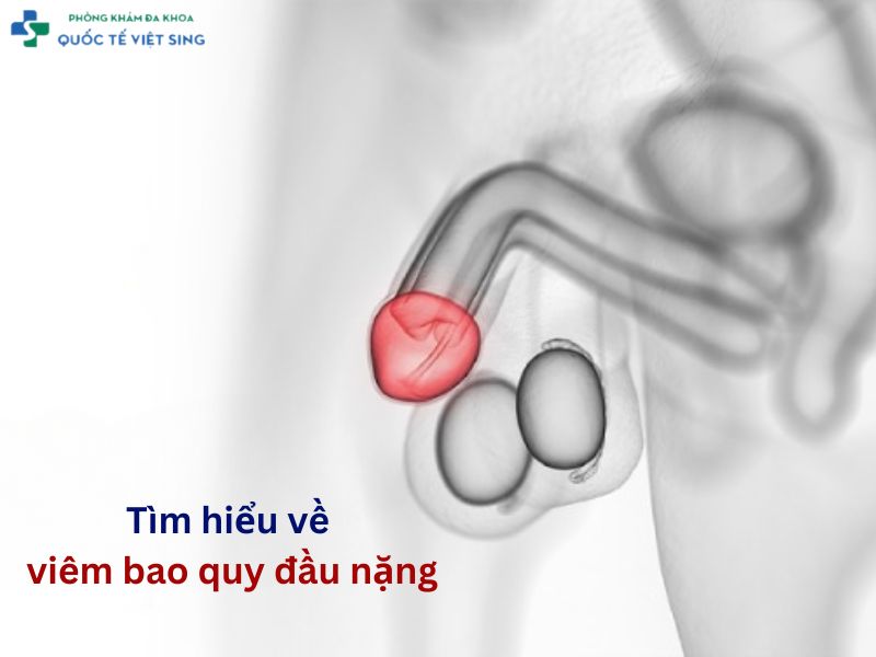 viêm bao quy đầu nặng
